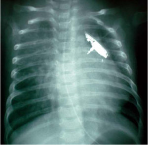 Chest x-ray with the FloWatch device implanted